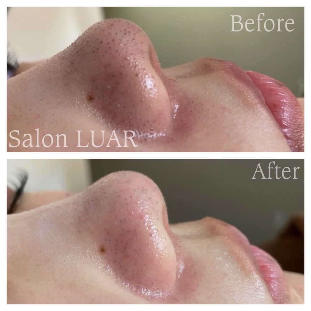 ハイドラフェイシャル施術例01