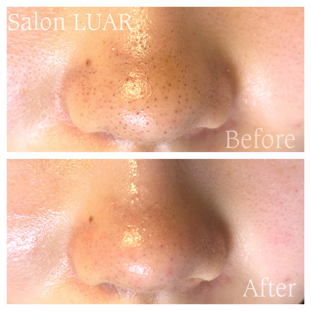 ハイドラフェイシャル施術例03