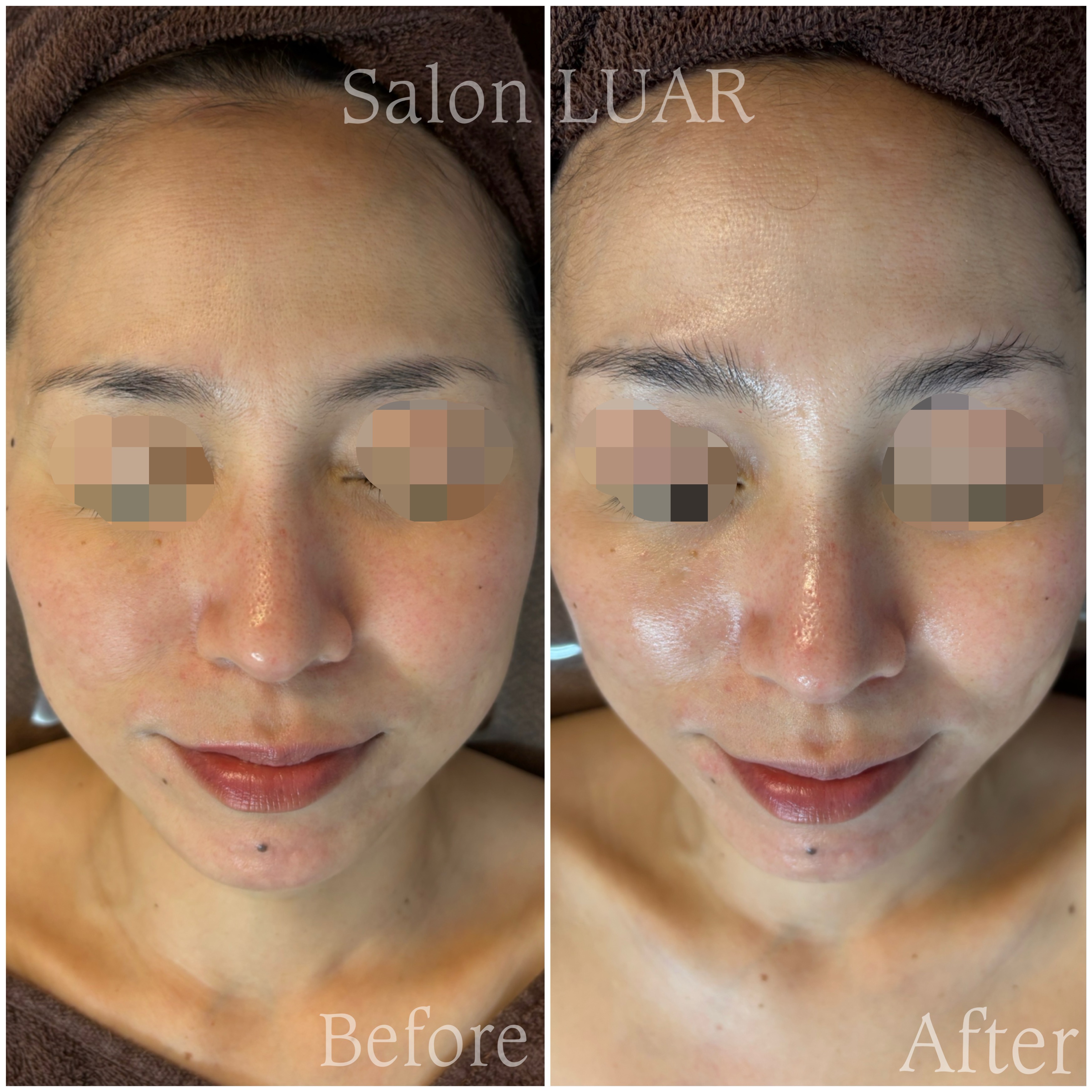 マーメイドセルトリートメント施術例01